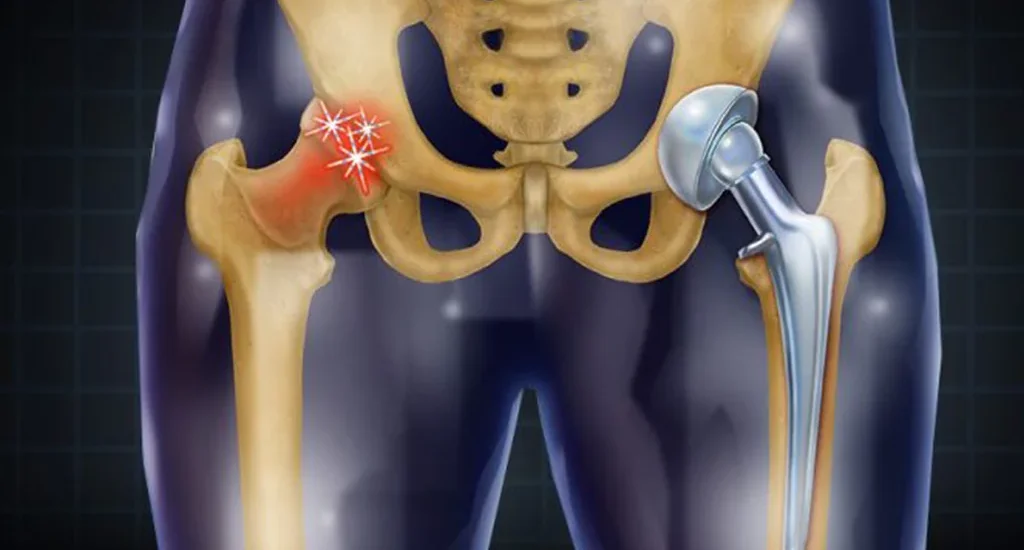 Hip Replacement